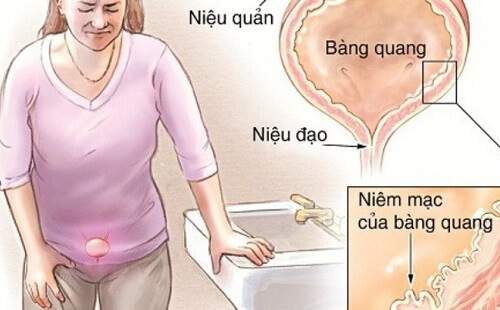 Bệnh viêm bàng quang ở nữ